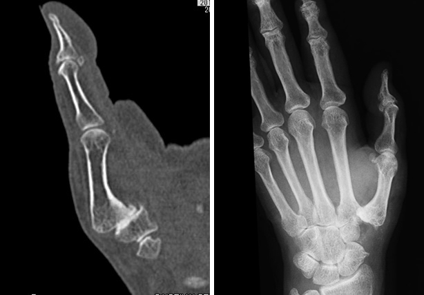 母指CM関節症に対する関節形成術