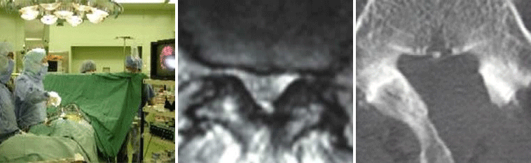 腰部脊柱管狭窄症に対する顕微鏡視下手術